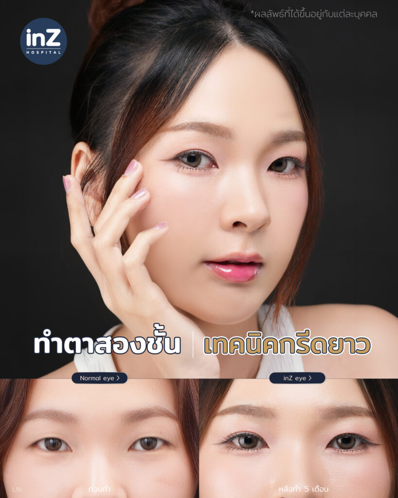 การทำตาสองชั้น วิธีต่างๆ ในปัจจุบัน ข้อดี-ข้อเสีย