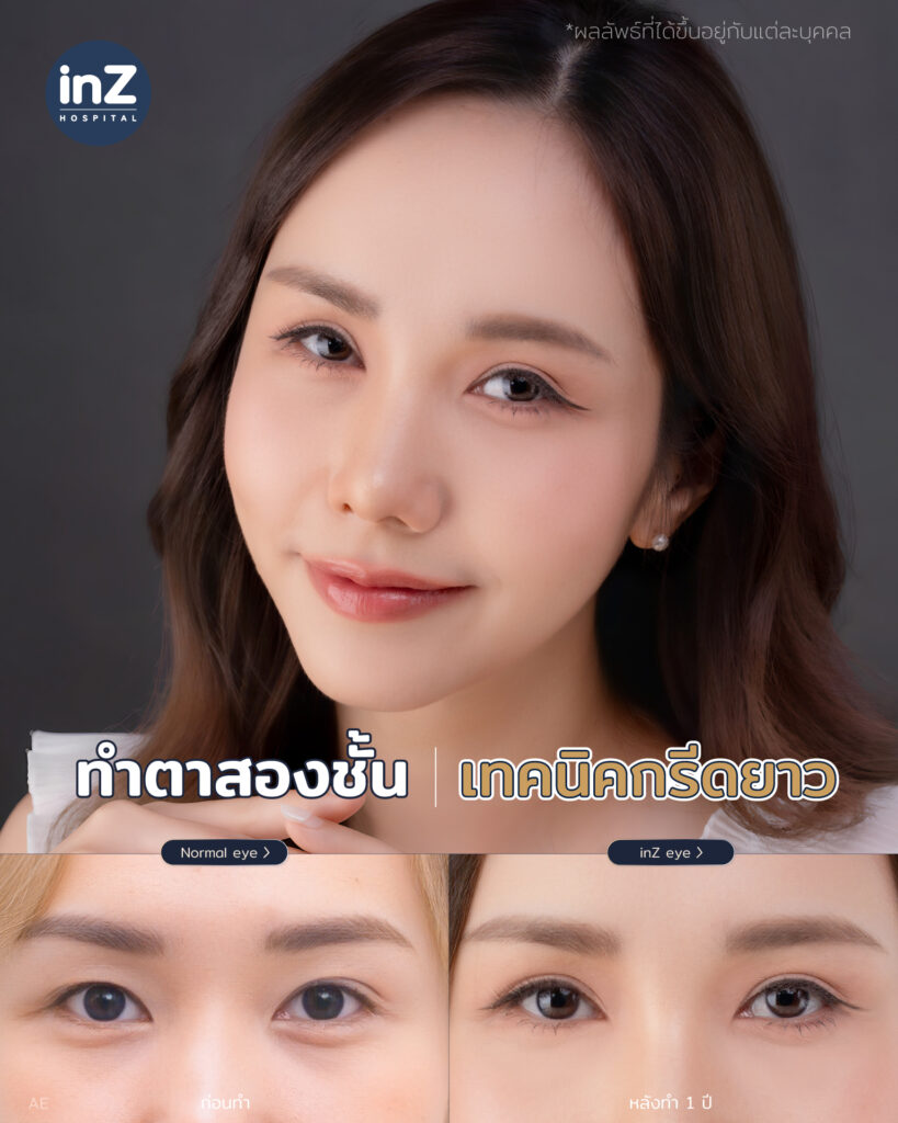 การทำตาสองชั้น วิธีต่างๆ ในปัจจุบัน ข้อดี-ข้อเสีย