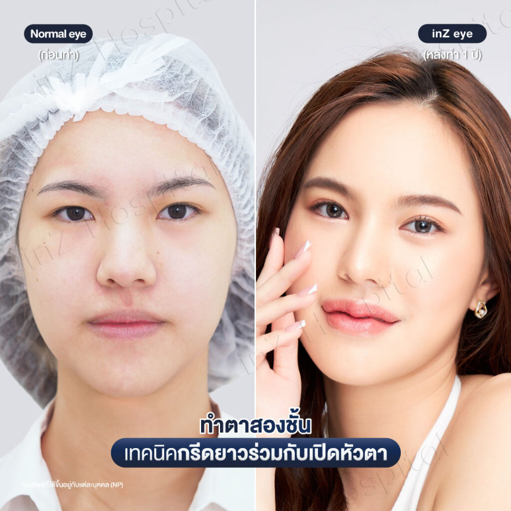 โปรโมชันทำตาสองชั้นเทคนิคกรีดยาวที่ inZ