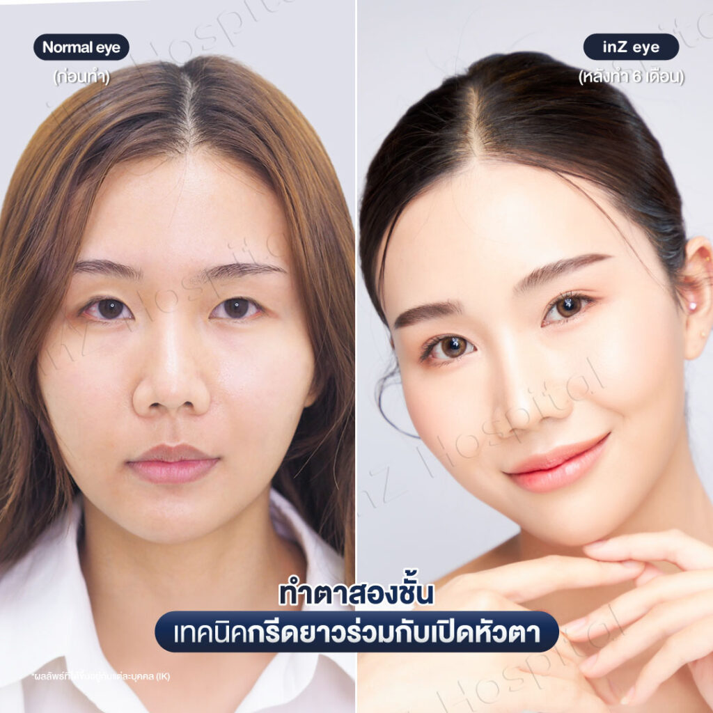 การทำตาสองชั้น วิธีต่างๆ ในปัจจุบัน ข้อดี-ข้อเสีย