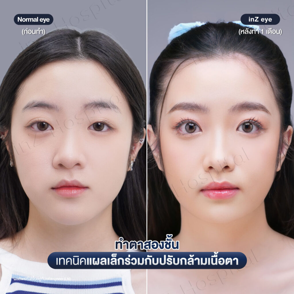 การทำตาสองชั้น วิธีต่างๆ ในปัจจุบัน ข้อดี-ข้อเสีย