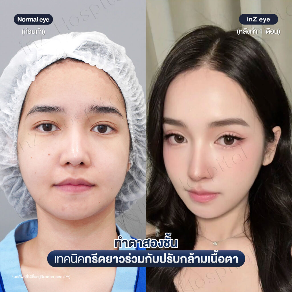 โปรโมชันทำตาสองชั้นเทคนิคกรีดยาวที่ inZ
