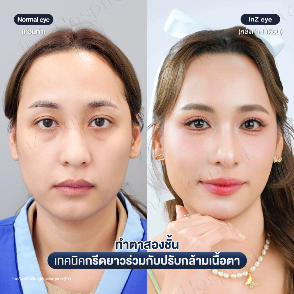 การทำตาสองชั้น วิธีต่างๆ ในปัจจุบัน ข้อดี-ข้อเสีย