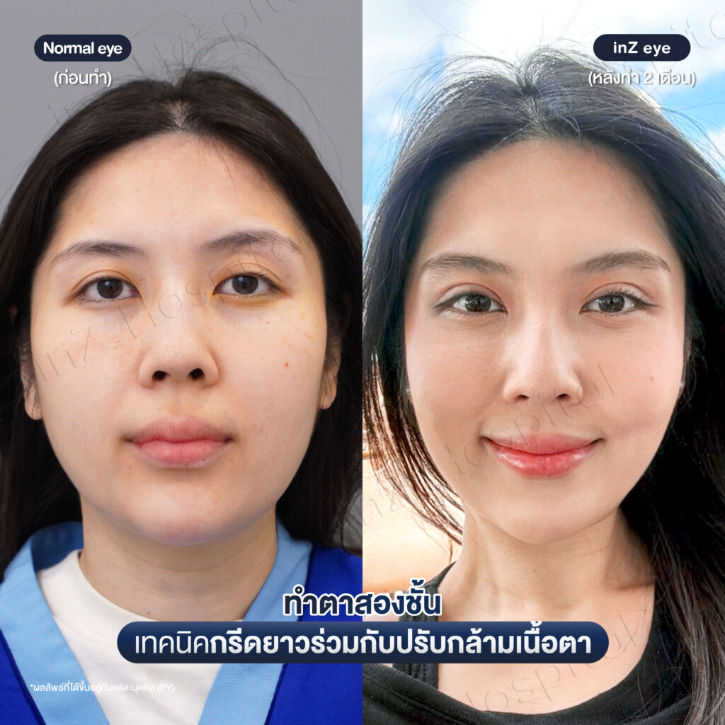 การทำตาสองชั้น วิธีต่างๆ ในปัจจุบัน ข้อดี-ข้อเสีย