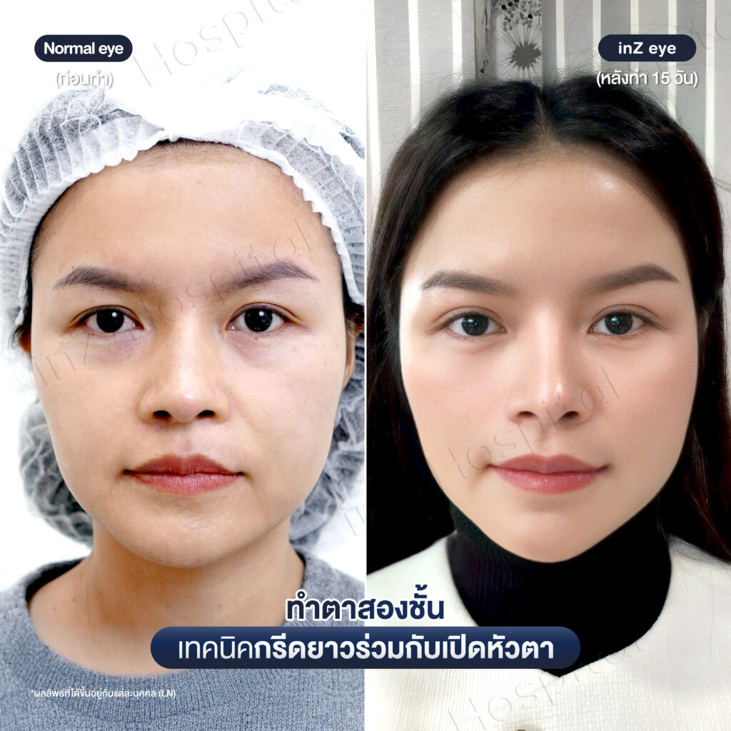การทำตาสองชั้น วิธีต่างๆ ในปัจจุบัน ข้อดี-ข้อเสีย