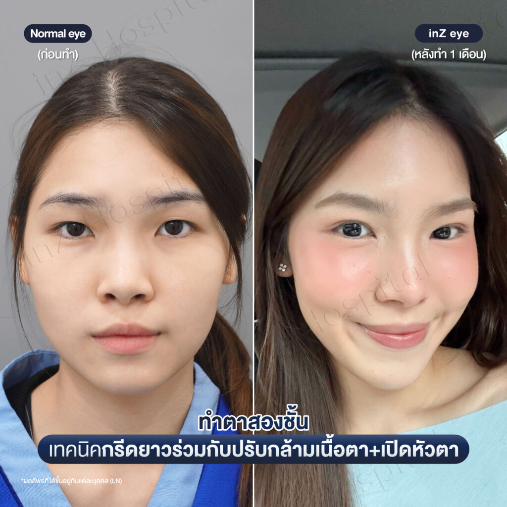การทำตาสองชั้น วิธีต่างๆ ในปัจจุบัน ข้อดี-ข้อเสีย