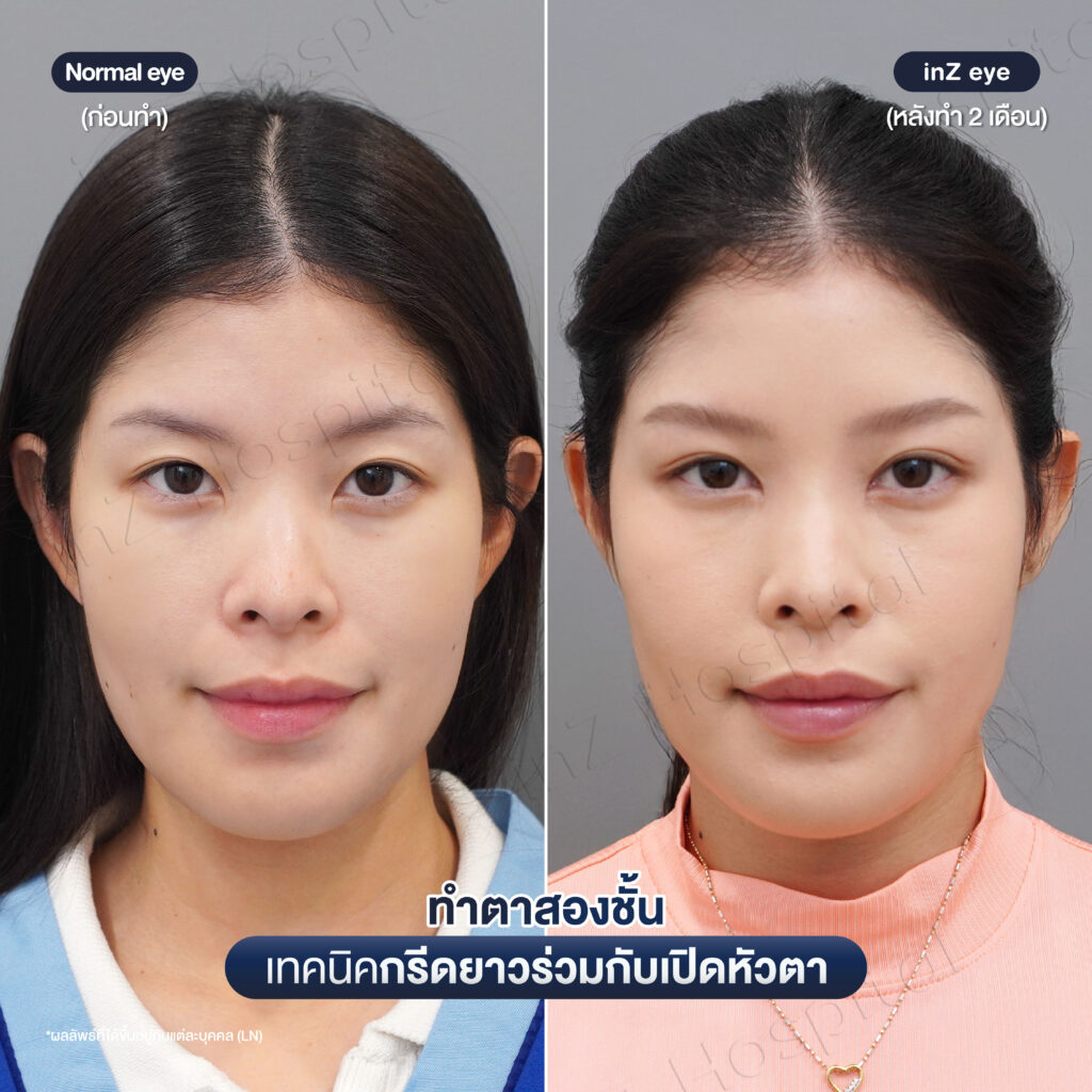 การทำตาสองชั้น วิธีต่างๆ ในปัจจุบัน ข้อดี-ข้อเสีย